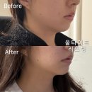 ALL(올)바른 PC | 부산 올타이트 효과 빠른 리프팅 피부과 전후 비교 후기 가격