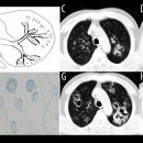 항진상회 | 침습성 폐 아스페르길루스증 (Invasive Pulmonary Aspergillosis, IPA)
