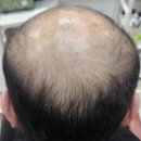 모이든가발 | 대구 정수리 탈모 고민 자연스럽게 해결한 후기(모이든증모가발 달서점)