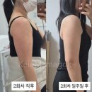 케이엠 | [마곡 팔뚝살 빼기] 케이엠에스테틱 후기