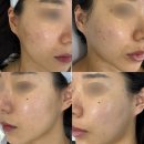 다빈레이저 | 클리어스팟 프로 “미작뷰티 강동점” 기미잡티 레이저 3회차!