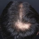 가메조네 | 영등포탈모병원, 비어 보이던 가르마 메조치료 4개월차 솔직 후기