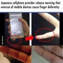 장시간 스마트폰 사용으로 인한 손가락 변형 이미지