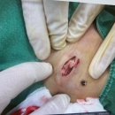 [수술 후기]송도유외과의원 표피 낭종 제거 수술 찐 후기_영업시간, 주차, 수술 사진 있음(주의‼️)