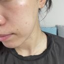 리쥬란힐러 한방울도 아낌없이 인젝터로 효과본 후기