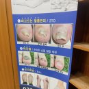 정관장부천역점 | 부평 무좀관리 레푸스 부평점에서 무좀발톱 스케일링해드린 후기