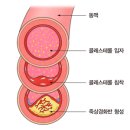 뇌졸중 이미지