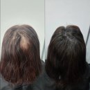 분당야탑3-A-6 | [분당야탑두피문신] 정수리·가르마 휑한 느낌, 블랙샌드뷰티에서 자연스럽게 커버해요