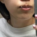 주걱턱 교정기 후 바뀐 옆모습, 주변에서 수술했냐고 물어봅니다