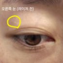 인계동 | ★[비립종 레이저 제거] 수원 인계동 피부과 후기★