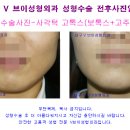 브이라인수술, 사각턱 보톡스,고톡스 비용, 코필러주사가격은? 대구성형외과 쁘띠성형 이미지