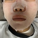 홍대피부과에서 문제성 피부 스킨부스터 포텐자콜라스터로 해결