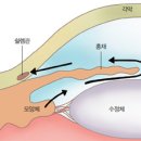 녹내장~! 알아야 막을수 있다. 이미지