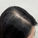이서에르 | 부산 양정 모발생장술 탈모에 확실히 효과있는 모리페어 에르에스테틱 메리티양정점