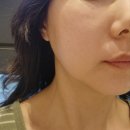 인터넷유니버스 | 광교역피부과 슈링크유니버스리프팅효과 후기