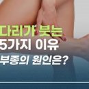 다리부종 원인 다리가붓는이유 알아볼까요 이미지