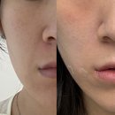 나도콜라겐이다 | 쥬베룩 볼륨 8cc 후기 l 6cc랑 뭐가 다를까? (콜라겐주사 8회차 강남 오드의원)