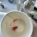 봄해치과의원 | 치과 검진 ( 사랑니 발치후기 )