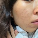 오 약 국 | 여드름패인자국 흉터레이저 쥬베룩시술 피부과 치료후기