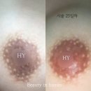 미랩 | 부천 미랩 멜라닌케어 효과 리얼 후기 [뷰티인하얀]