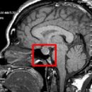 성선기능저하증[Hypogonadism]유방내분비질환 이미지