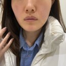 신촌카리스빌딩 | 신촌피부과에서 옆볼꺼짐으로 땅콩형얼굴에게 최고인...4CC 시술받고 온 솔직후기 / 결혼식 본식 10...