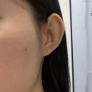 바른뿌리한의원 | 신사 피부과 한의원 | 패인 흉터 제거 | 새살침 치료 | 1회차 후기