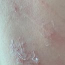 미니스톱 봉생병원신관점 | 20대 대상포진 후기_나 혼자 주절주절 쓰는 솔직 후기