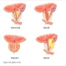 전립선 암에 좋은 음식과 나쁜 음식 5가지 이미지