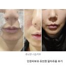 멍끌림 | 인천쥬브젠 팔자주름｜구월동피부과 솔직후기 (통증·효과·가격)
