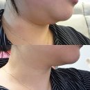 [평택/서정] 은월테라피 :: 이중턱에 효과 너무 좋은 평택 윤곽관리 평택피부관리 평택웨딩관리