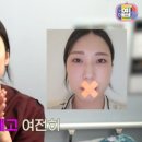 [유아현 2편] 입술 빼고 다 했다! 사각턱+윗트임+코+지방이식 4개월 차 후기