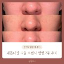 필약국 | 의정부 포텐자 펌핑 후기 | 모공 때문에 스트레스 받던 피부 2주 변화[내돈내산]