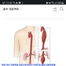 흉부 대동맥과 복부 대동맥에 극한 살인 난도질하는 중. 이미지