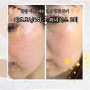 하얀도화지 | 진짜 내돈내산 한달후기! 피코토닝 + 제네시스 후기입니다