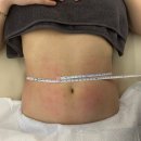 예쁜똥배 | 부산웨딩관리 슬리밍관리 해운대 미엘르 / 빼고싶다 똥배싹둑 효과 만점