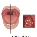 편도결석 빼는법 5가지 : 원인 제거 병원 이미지