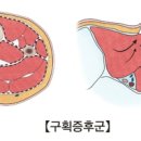 ﻿구획증후군 (Compartment syndrome) 이미지