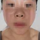 청담서클의원 | [웨딩준비] 청담서클의원에서 얼굴 소멸시키고 광내기 (소멸레이져, 하이드라페이셜 후기)