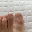 광화문 종로) 레푸스 관리 후기 🦶🏼