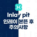 본치과기공소 | 헤리치과 Inlay pit 인레이 본뜬 후 주의사항