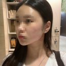 압구정역피부과 물방울인모드리프팅 받고 효과 본 솔직 후기 (통증 멍/시술 후 술)