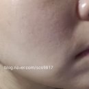 300 | 인천 구월동 피부과 올리지오 300샷 후기