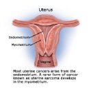 자궁내막암진단방법 알아봅시다 이미지