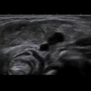 Fibromatosis colli 이미지