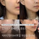 압구정튠모드(튠페이스+인모드) 이중턱,심부볼은 지방사멸/리프팅+ 모공까지 쫀쫀해진 후기