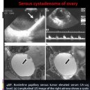 Serous cystadenoma of ovary 이미지