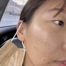 더라움의원 | 리투오 효과 시술 후 / 일주일 후기, 내돈내산!