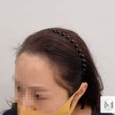 미로헤어라인 이미지