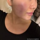 (주)팜메디 | 부평역 근처 피부과 브이메디스파 | 20대 피부관리 | 여드름 흉터 홍조 예민피부| 내돈내산